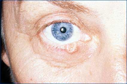 Eyelid Tumor Treatment Lancaster PA