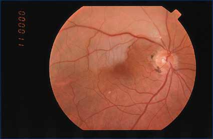 Retinal Artery Occlusion Lancaster, PA