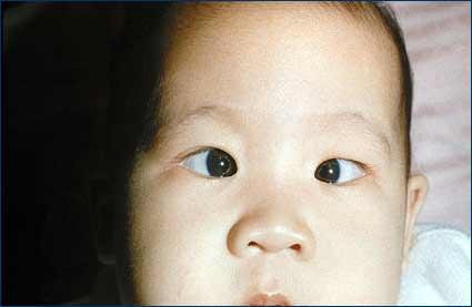 Baby Vision Impairment Lancaster, PA