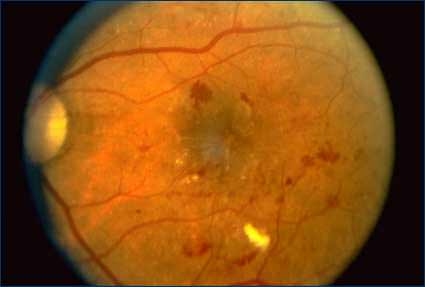 Proliferative Diabetic Retinopathy Treatment Lancaster, PA