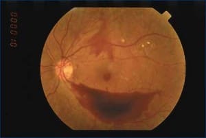 pigmentosa retinitis lititz pa elizabethtown